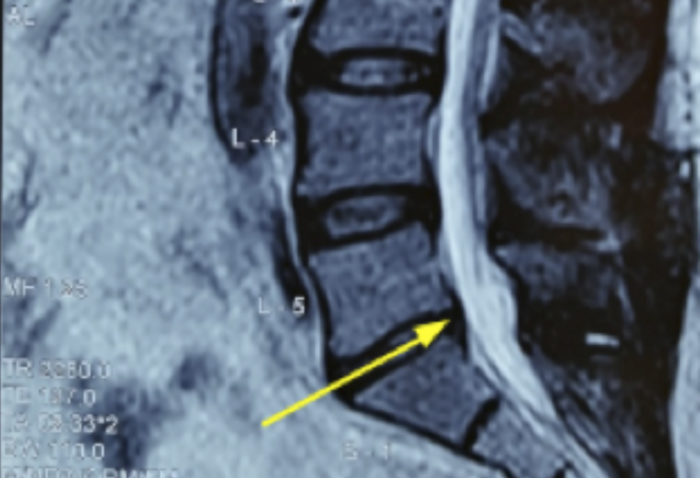 Sic Medical Hernia De Disco · Laminectomía 